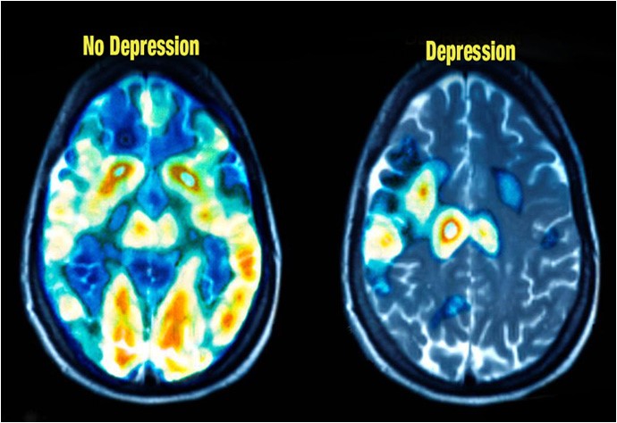 Two mri images with the words no depression and depression.